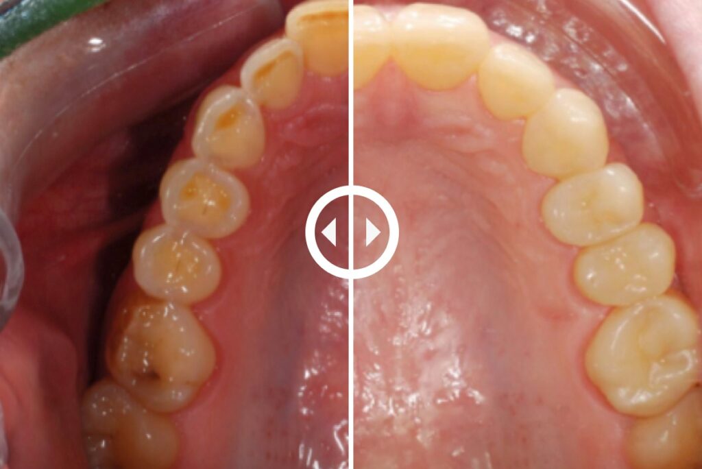 Align and Restore Case